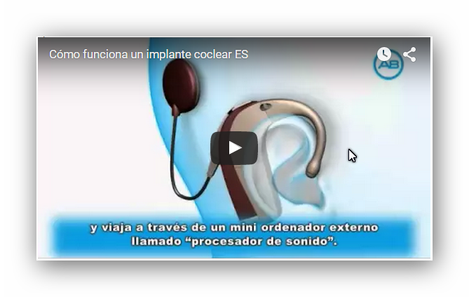 Como funciona implante Coclear
